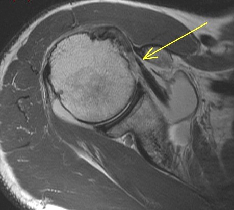 Figure 2 for case Supraspinatus and subscapularis tears involving the anterior rotator cable